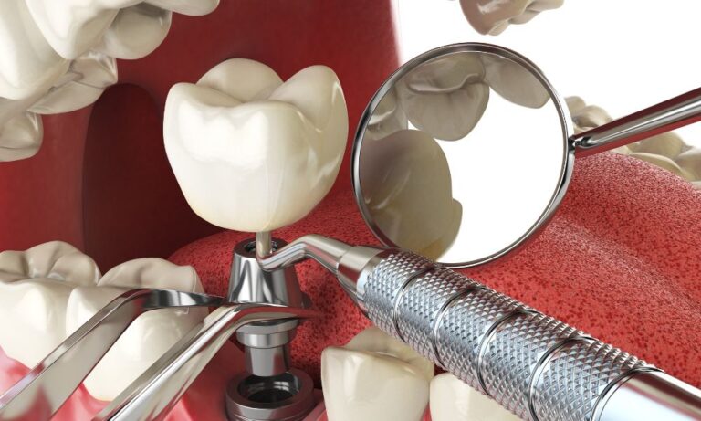 A Comprehensive Guide to Dental Implant Aftercare for Broomfield Residents