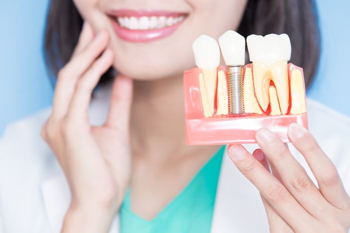 Top Dental Implants Benefits