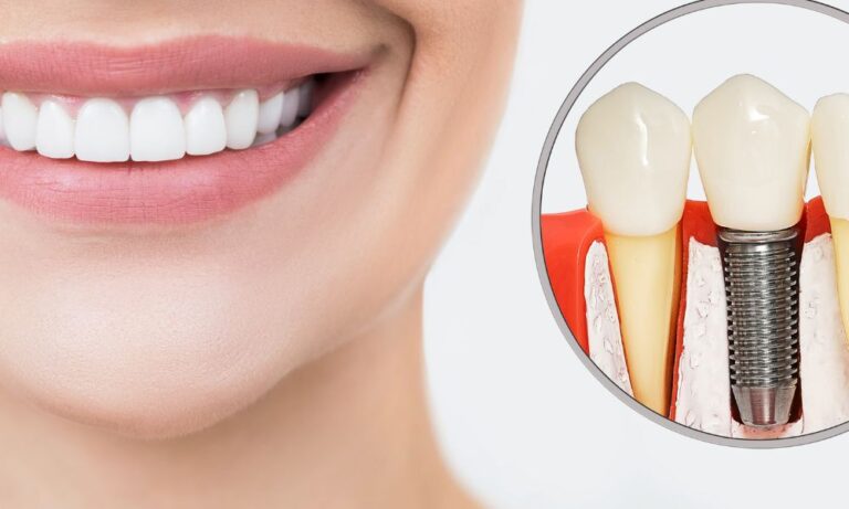 Your Smile with Dental Implants