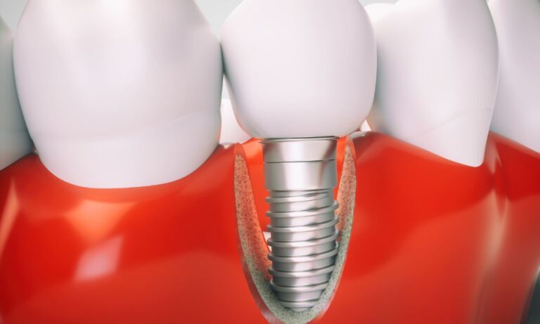 Dental Implant Solutions in Northglenn: A Comprehensive Guide to Restoring Your Smile