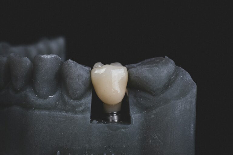 Dental Implants vs. Dental Bridges: Comparing Treatment Options