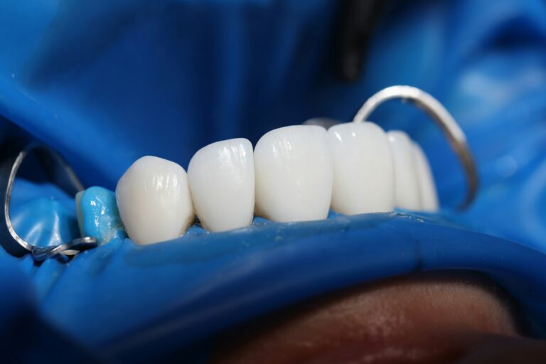 The Role of Dental Implants in Restoring Gum Health and Functionality: A Comprehensive Guide