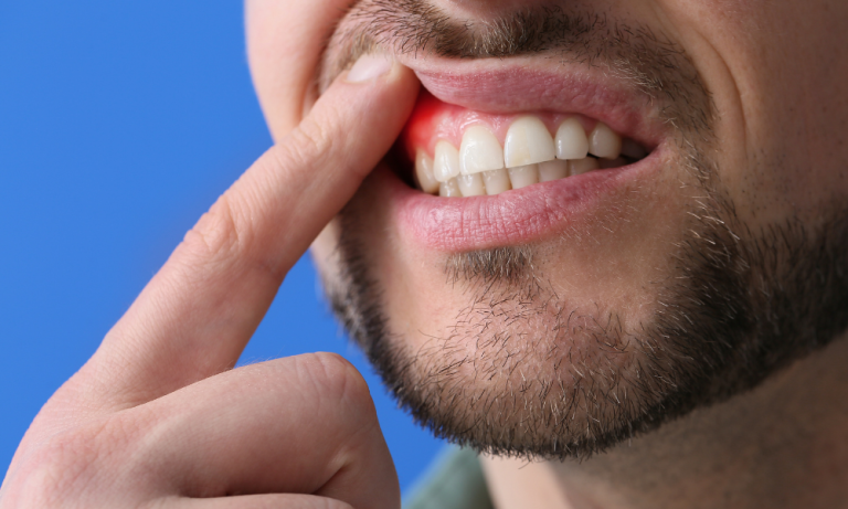 Why You Shouldn’t Ignore Bleeding Gums